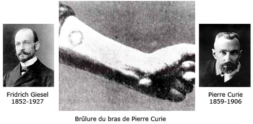 Photo des brûlures occasionnées par le radium sur le bras de Pierre Curie